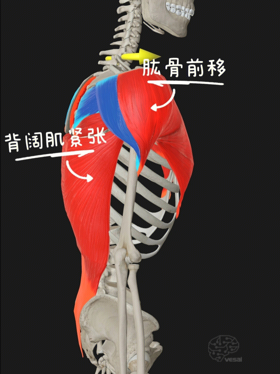 87形成原因:肱骨内旋肌群紧张(包括:胸大肌,胸小肌,三角肌前束,大圆