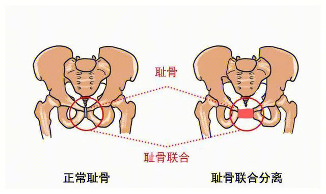 耻骨疼是什么位置图片图片