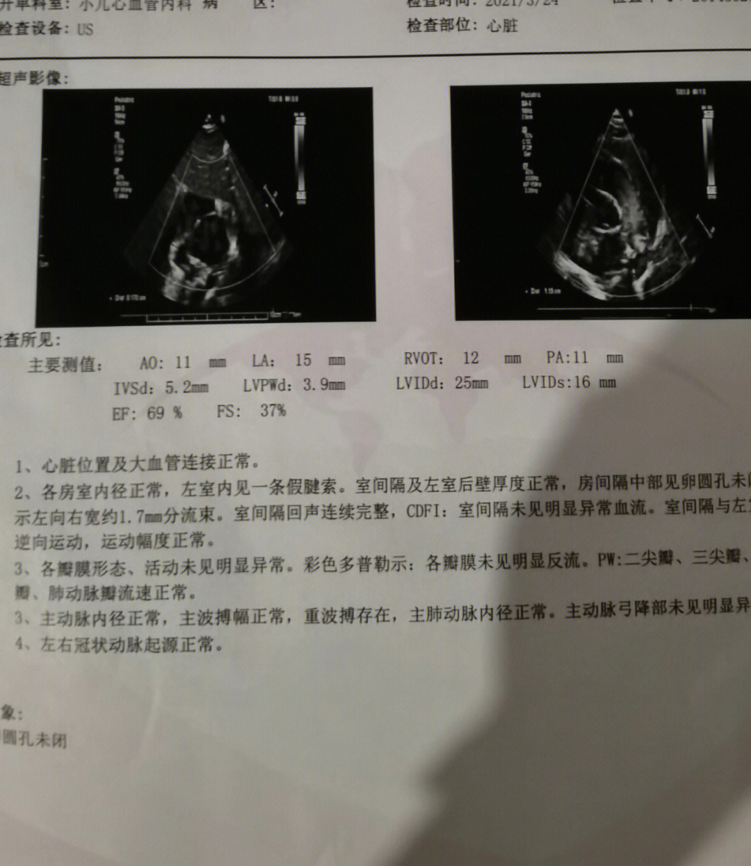 卵圆孔闭合时间图片