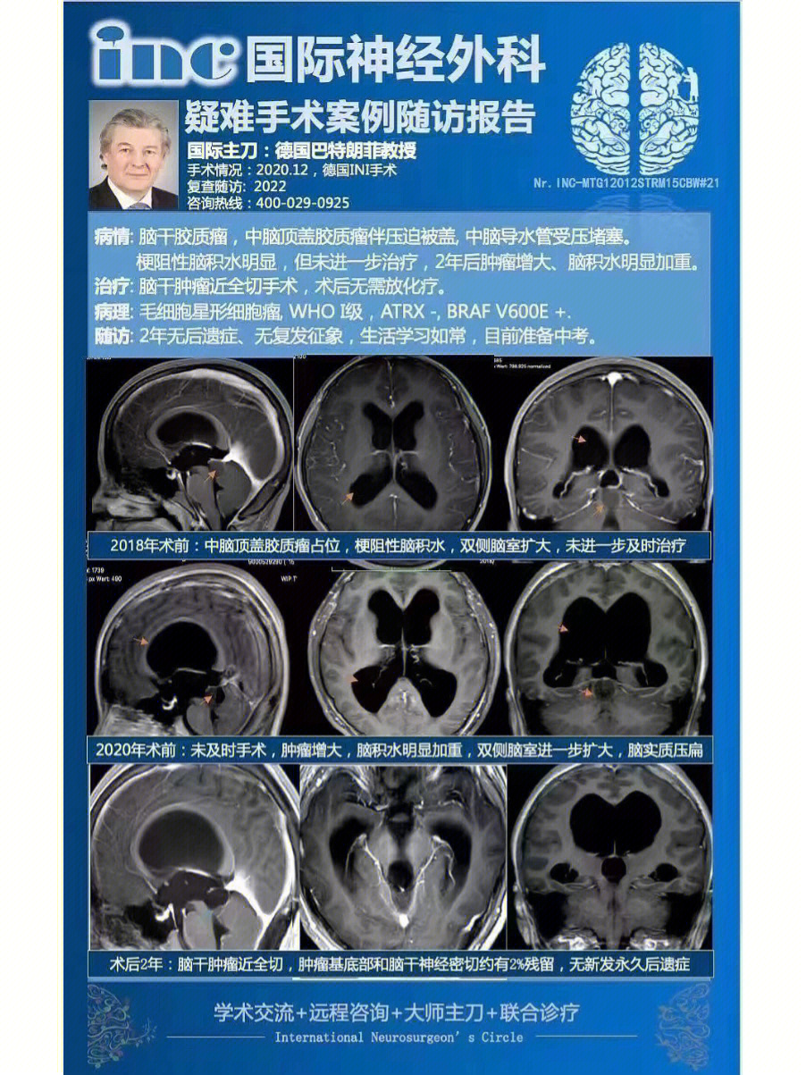 哪一类胶质瘤可手术根治生存长达50年