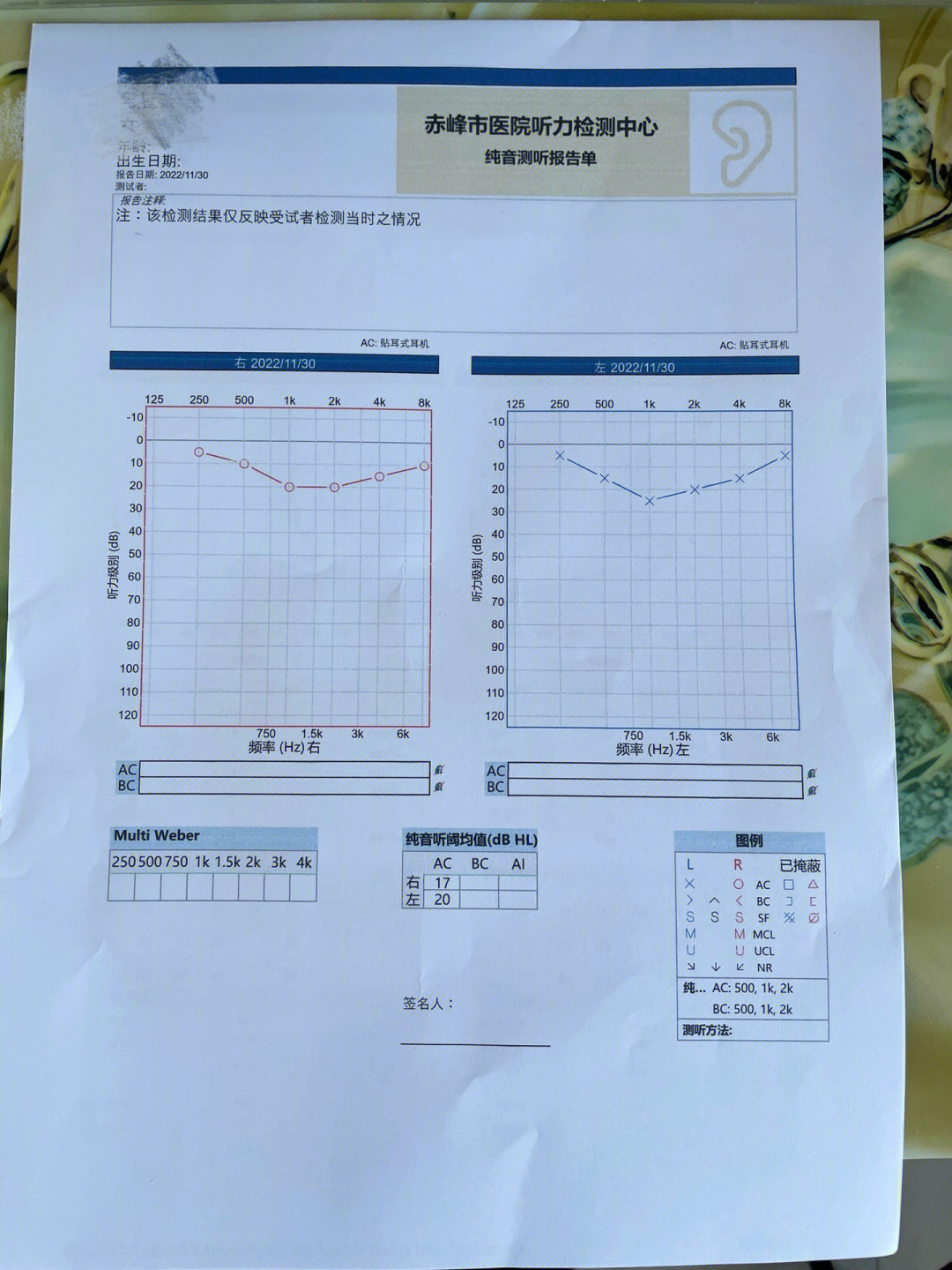 纯音测听报告正常图片图片