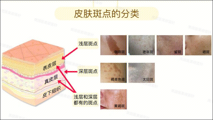 咖啡斑如何治疗图片