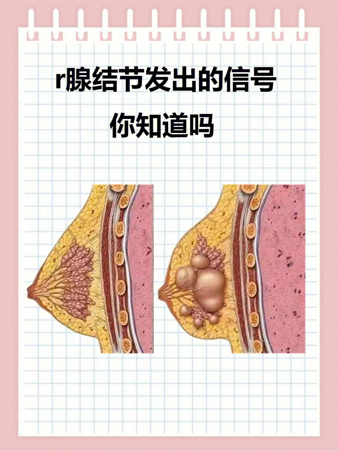 乳腺结节图片 症状图片