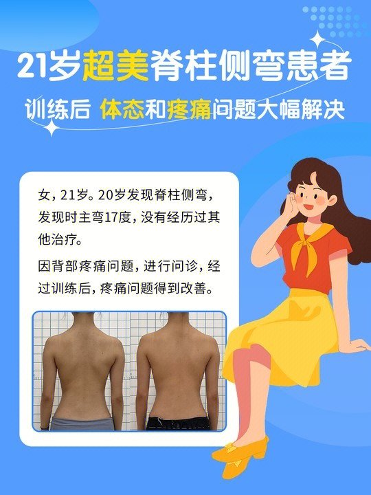 20岁发现脊柱侧弯,发现时主弯17度,没有经历过其他治疗.