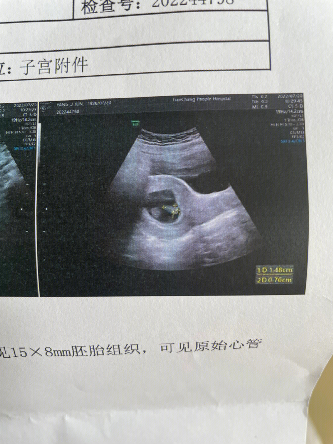 女孩胎囊图片图片