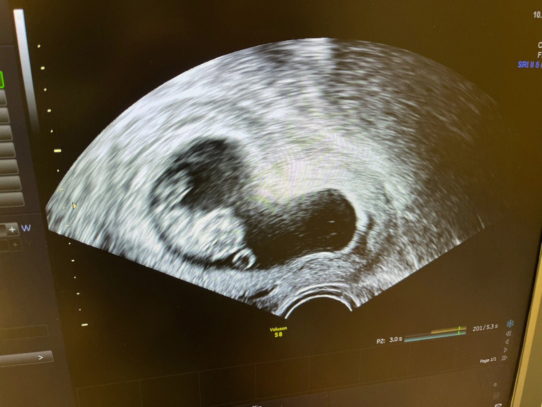 胎儿各径线标准图图片