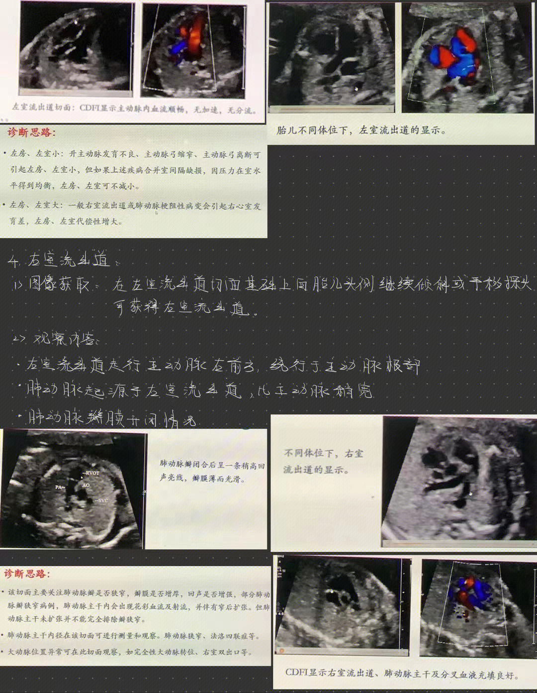 胎儿心内膜垫缺损图片