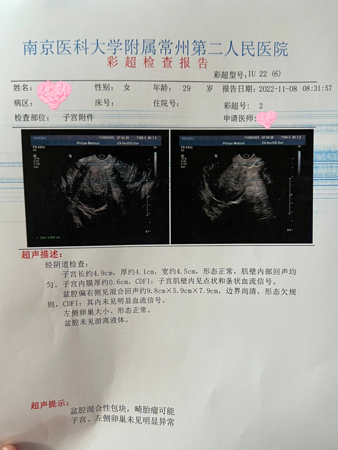 畸胎瘤图片病理报告图片