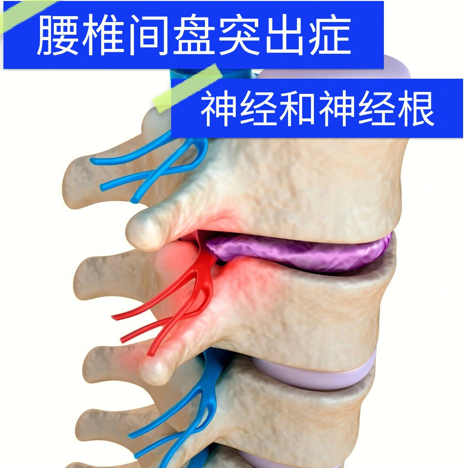 腰椎神经根水肿图片图片