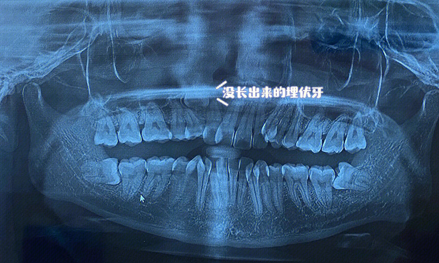 横向埋伏牙图片