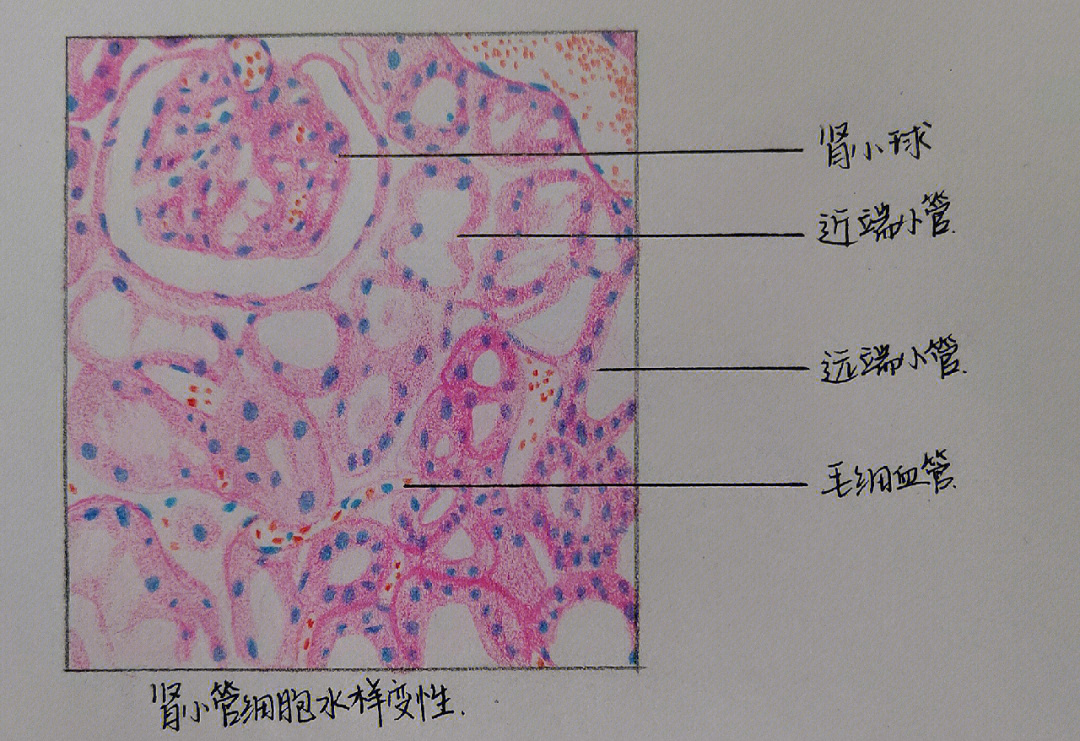 肾小管#病理切片#医学生的日常 肾小管细胞水样变性 病理切片