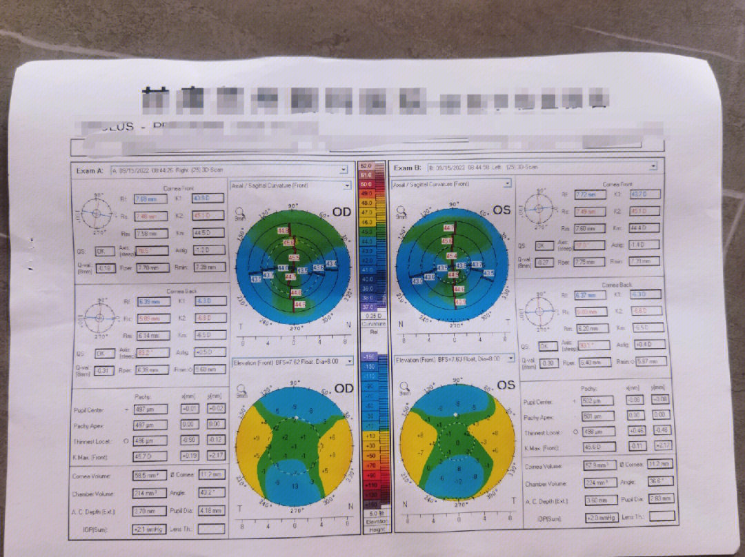 手术[种草r]眼睛的情况度数:右眼875 左眼825角膜厚度:497左右暗瞳:6
