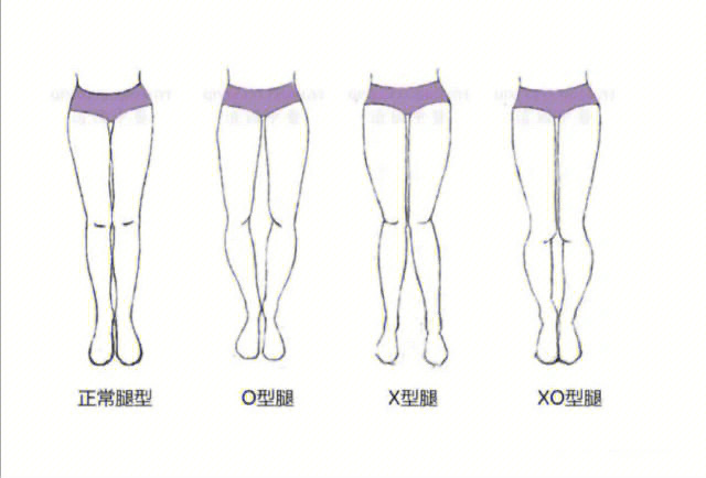 x型腿怎么造成的图片
