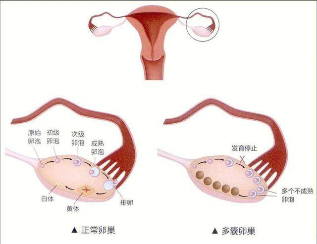 多囊卵巢综合症照片图片