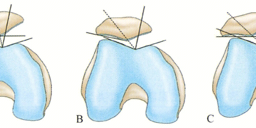 髌骨脱位示意图图片