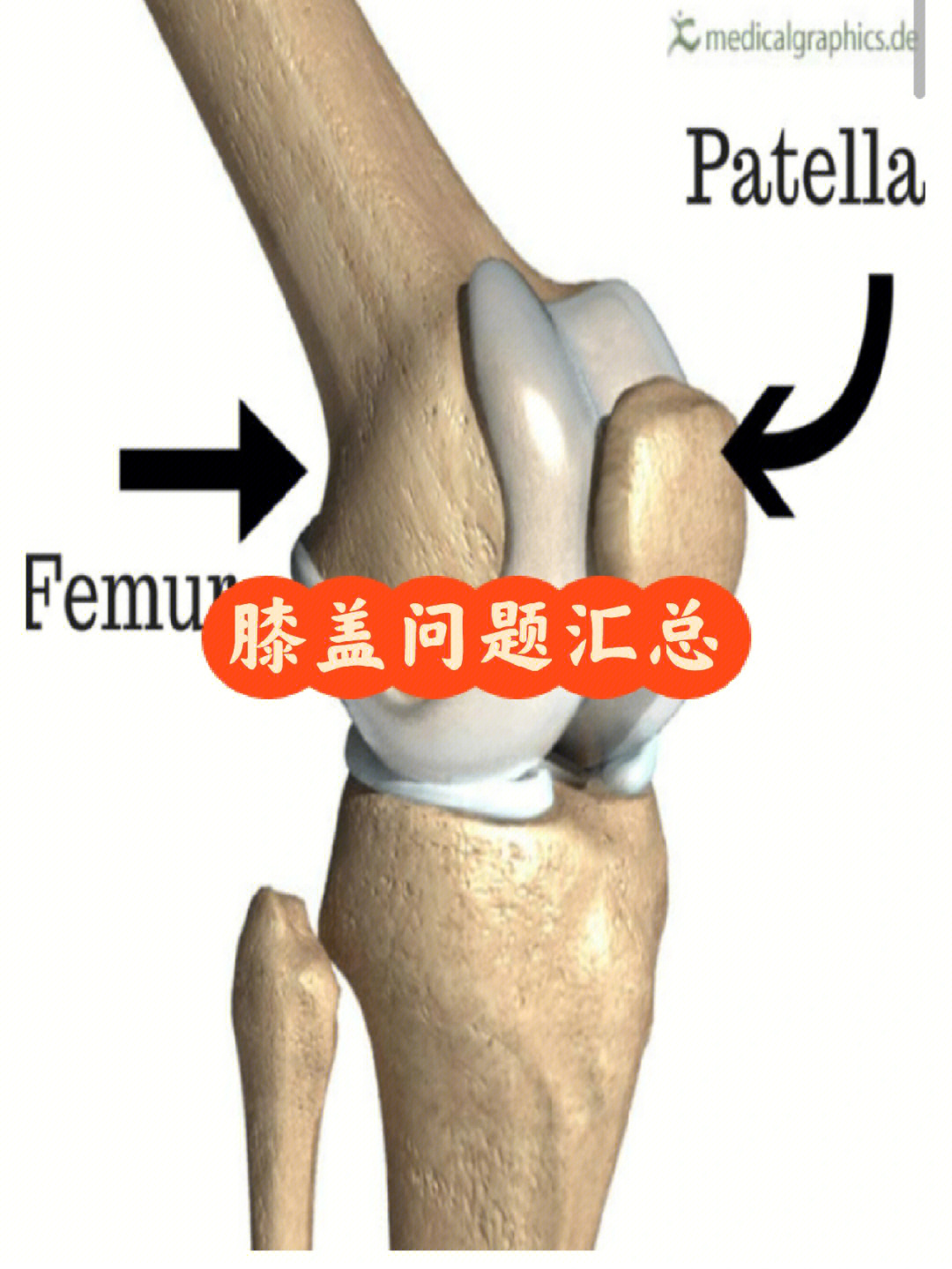 膝盖问题汇总