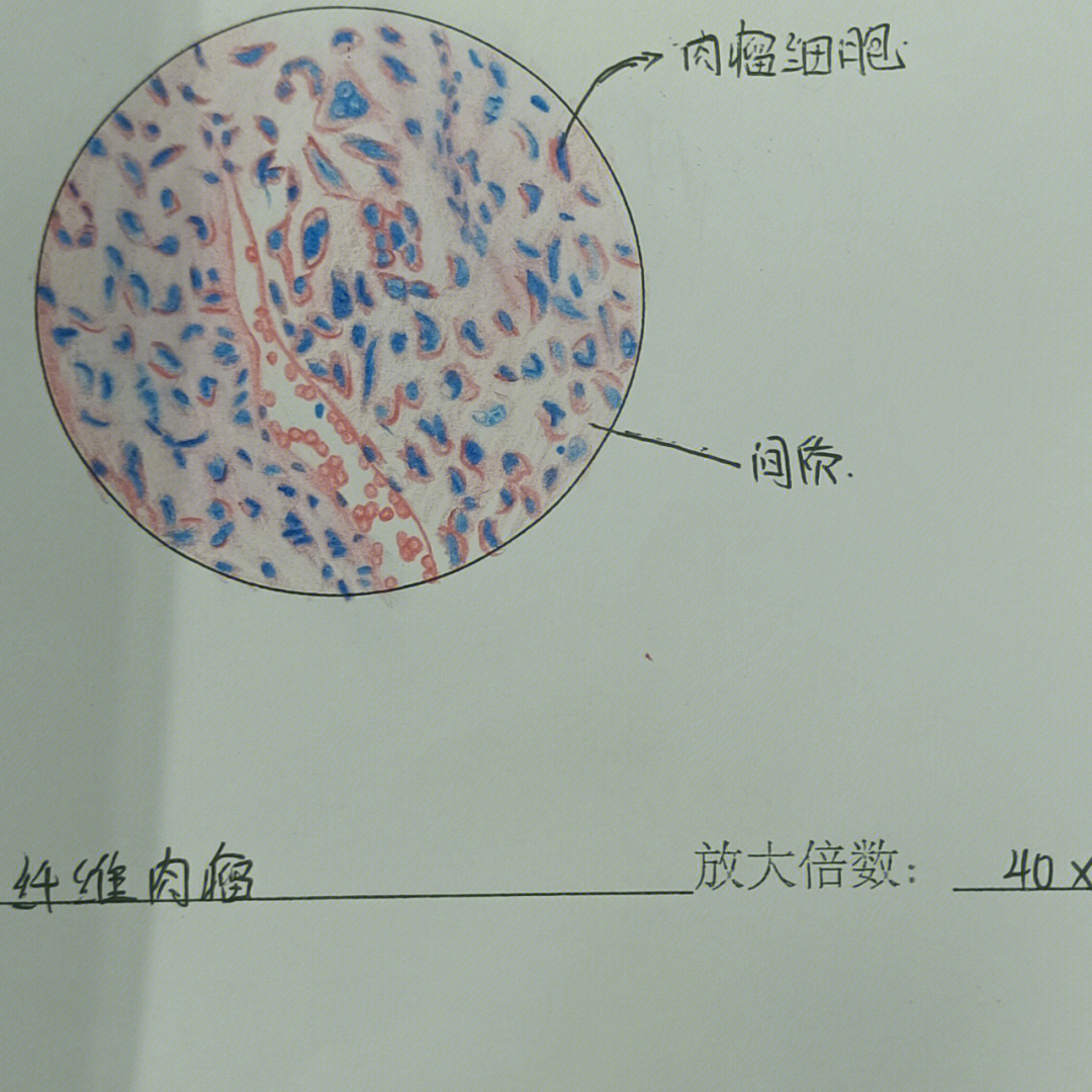 骨肉瘤红蓝铅笔图片
