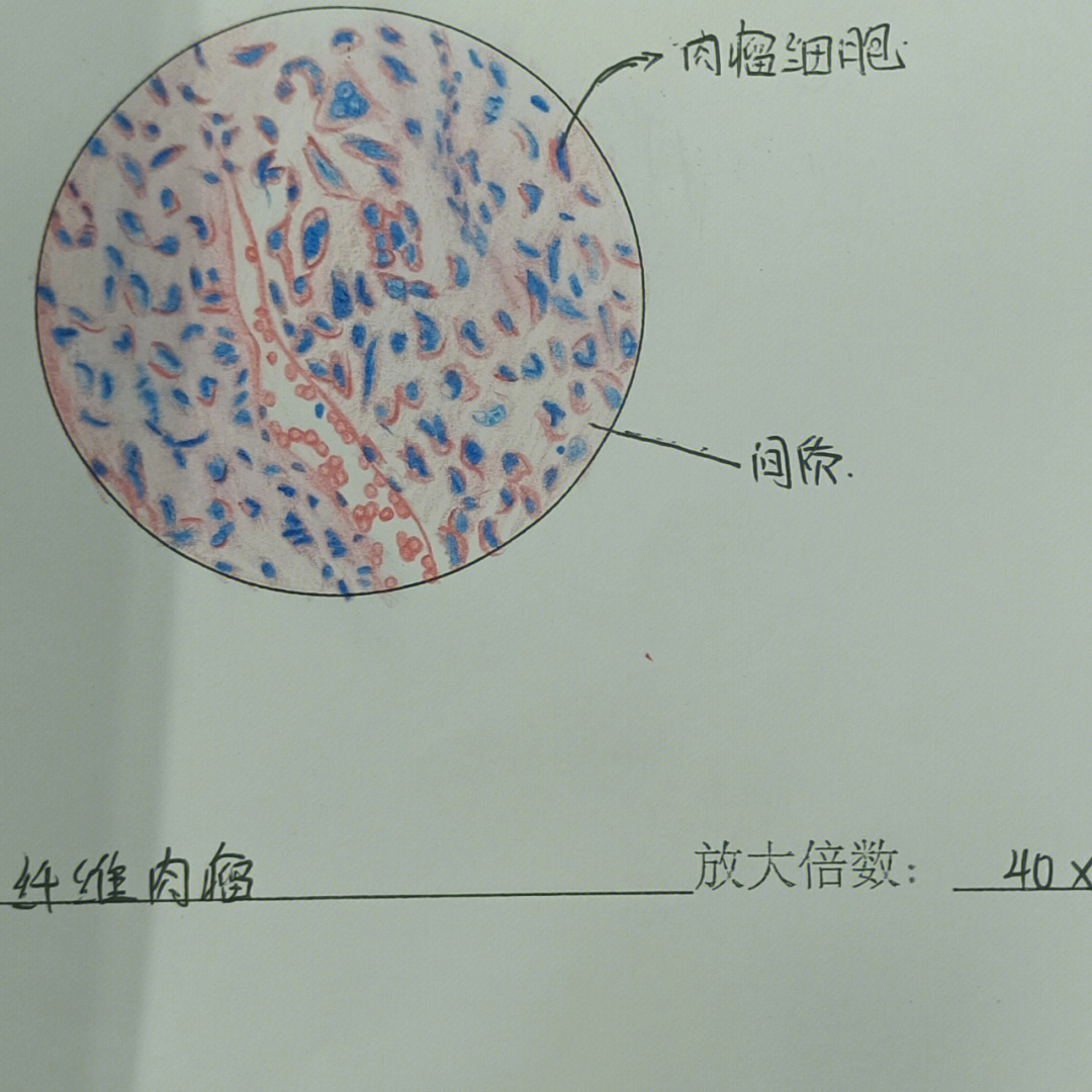 纤维肉瘤绘图图片