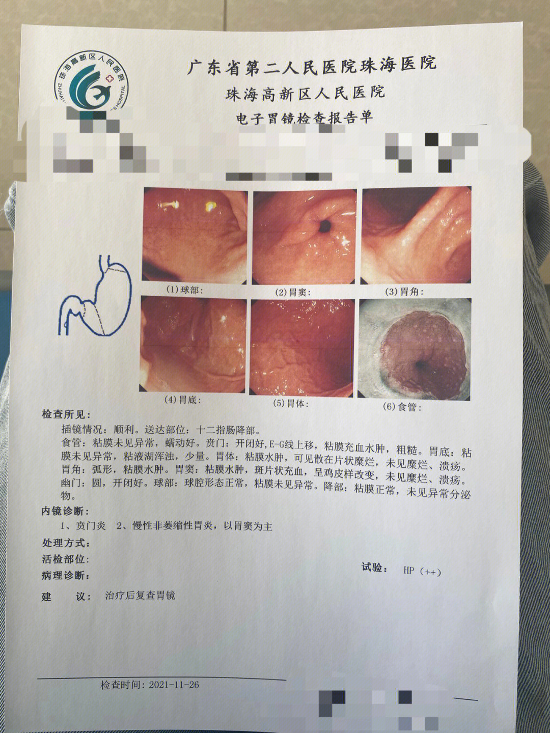 完全正常的胃镜报告图片