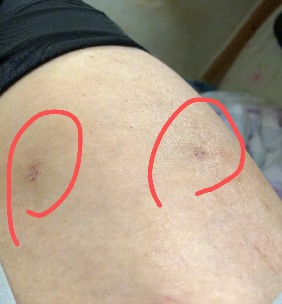 大腿抽脂后的疤痕照片图片