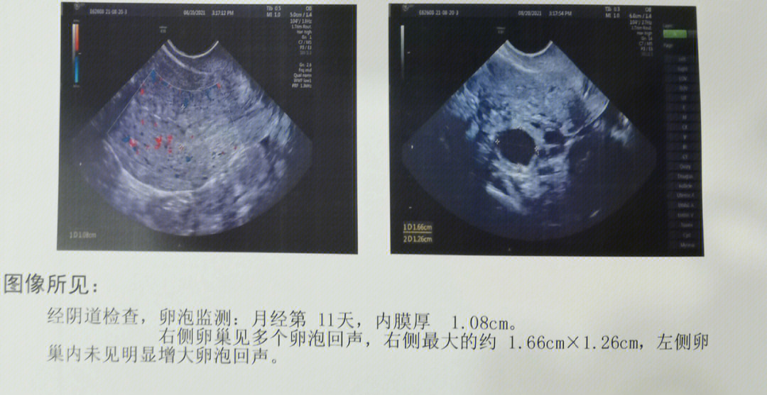 卵泡彩超图片图片
