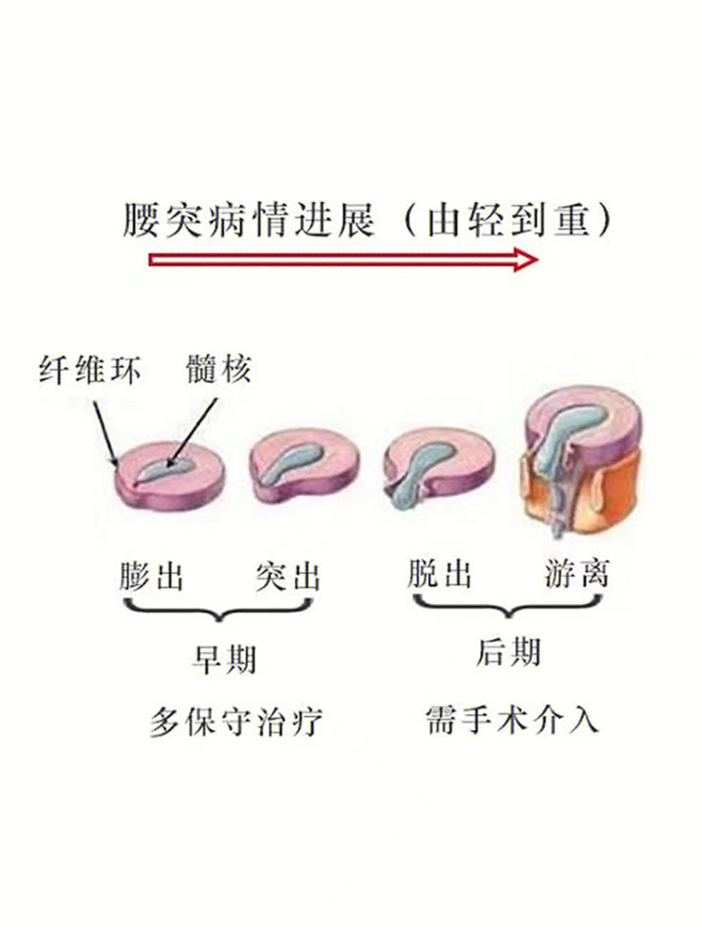 椎间盘突出分为椎间盘膨出,椎间盘突出,椎间盘脱出,椎间盘游离四个