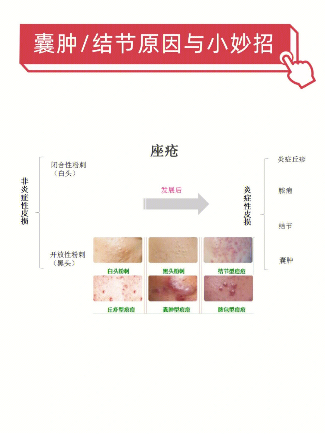 皮下囊肿如何治疗图片