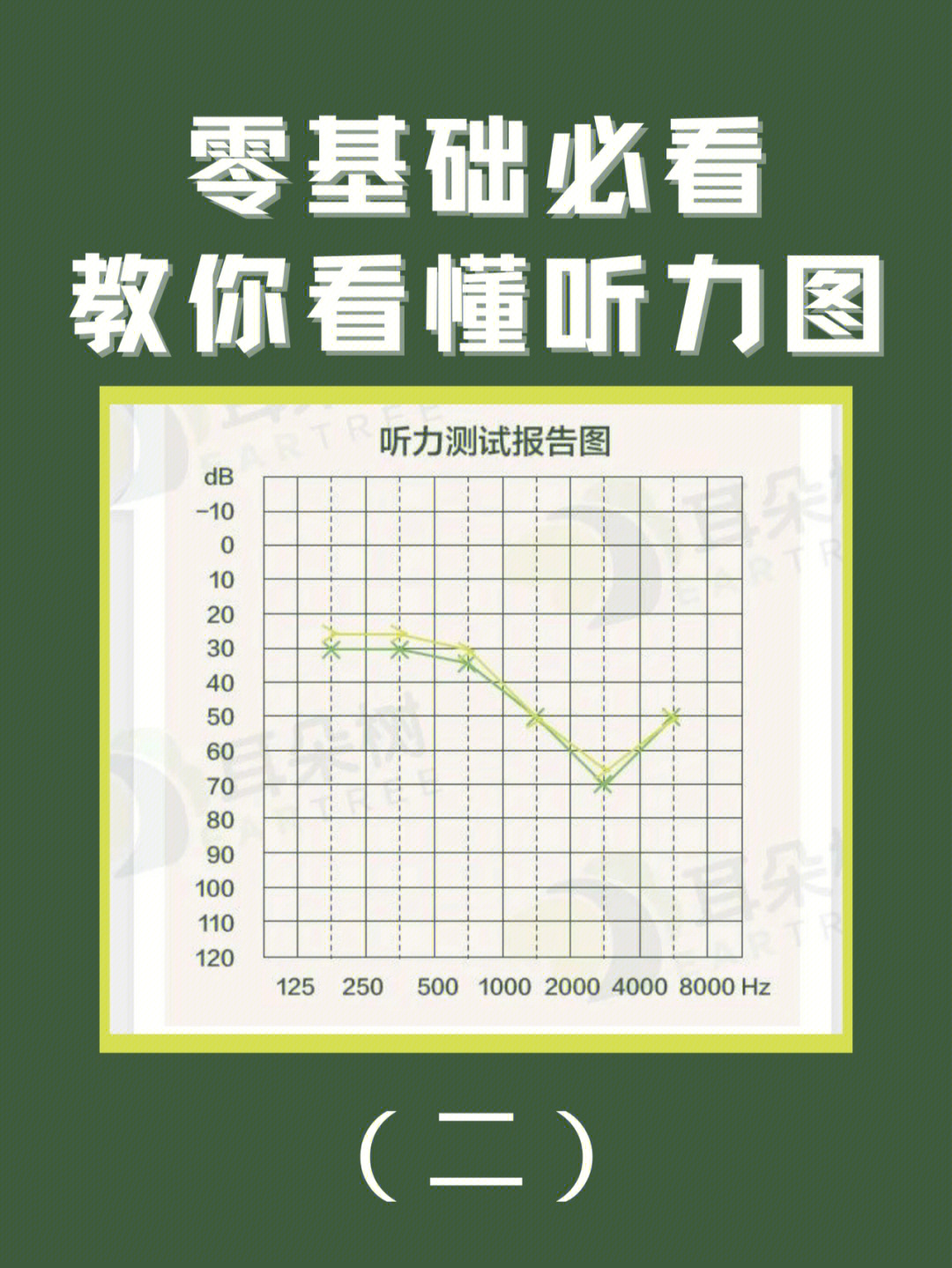 耳硬化症纯音测听图图片