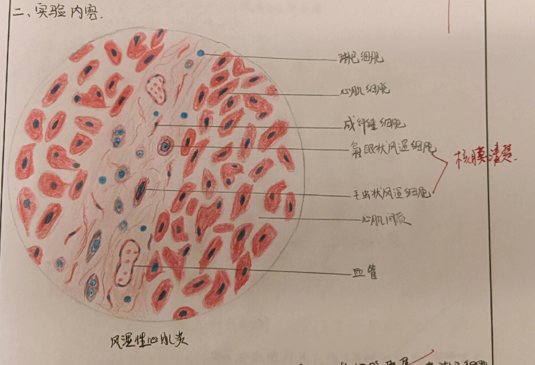 炎性细胞红蓝铅笔图图片