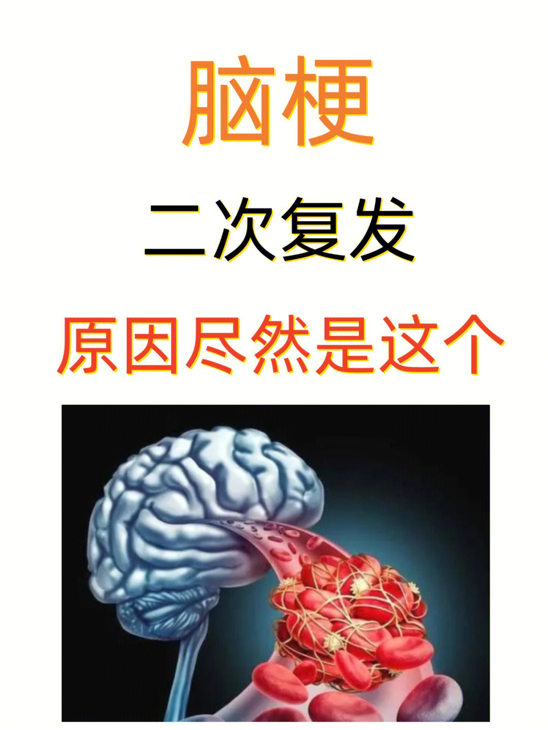 脑梗复发率图片