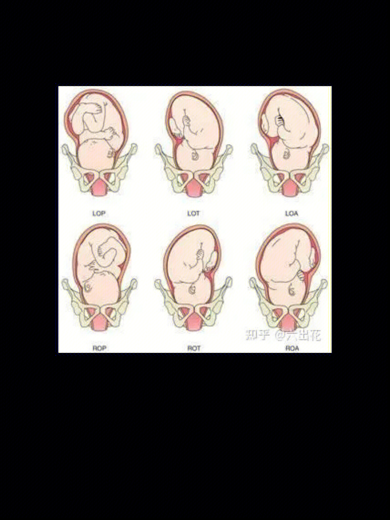 胎位图LOT图片