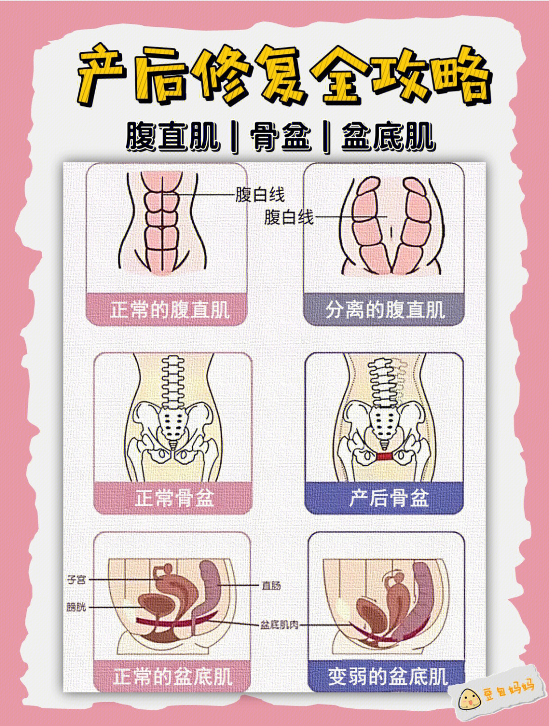 产后骨盆修复有必要吗图片