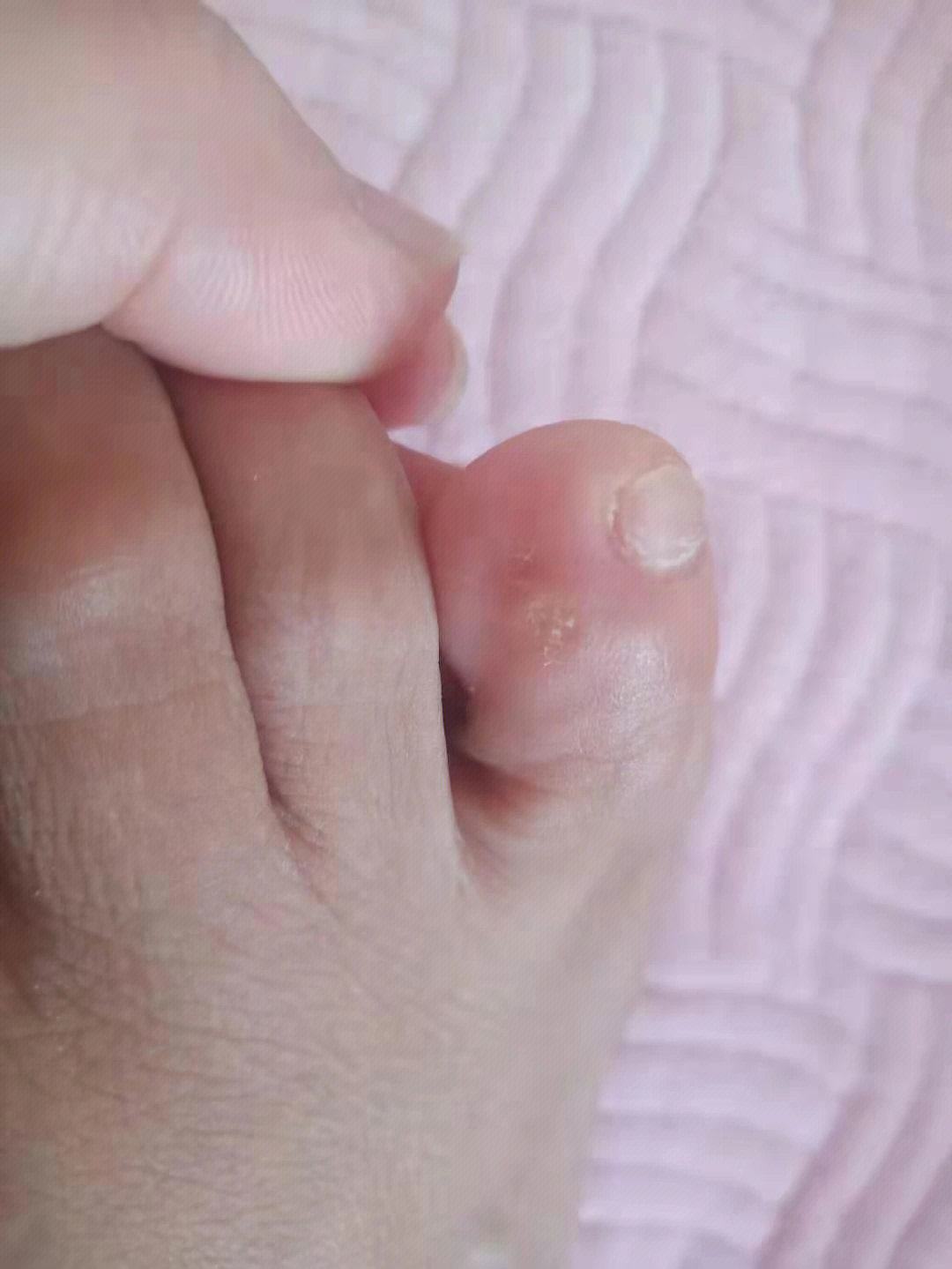 鸡眼完美修复日记以后就不要穿紧鞋子了
