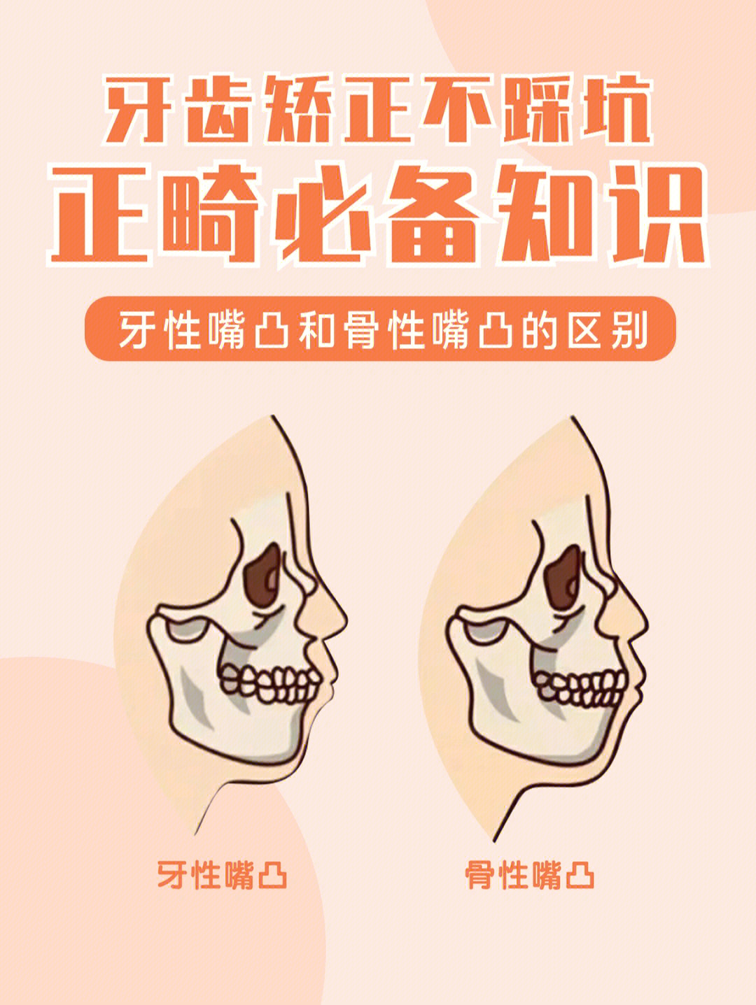 牙齿骨性前突怎么矫正图片