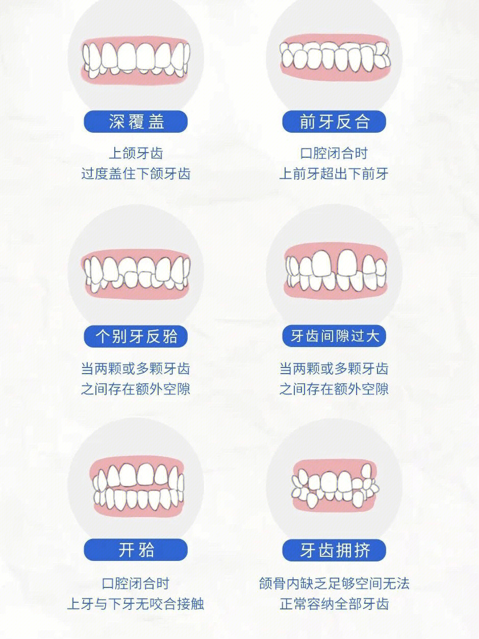 矫正牙齿的步骤跟过程图片