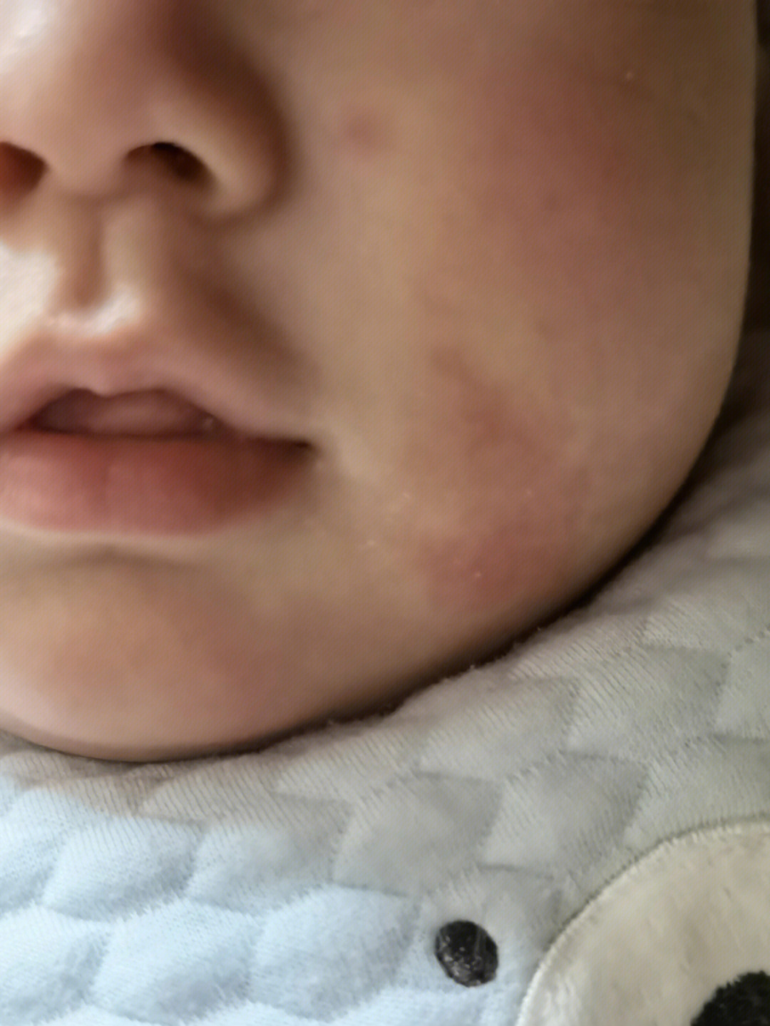 婴儿脸上长湿疹怎么治图片
