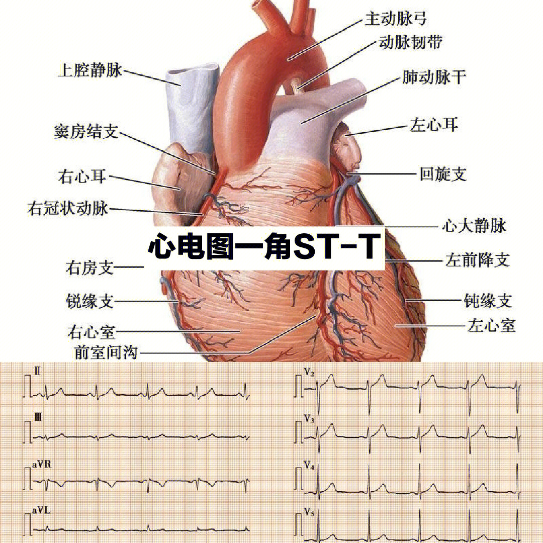 心电图st图解图片