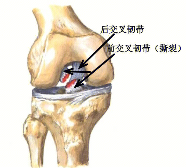 膝关节#前交叉韧带重建#前交叉韧带损伤#前交叉韧带重建术后