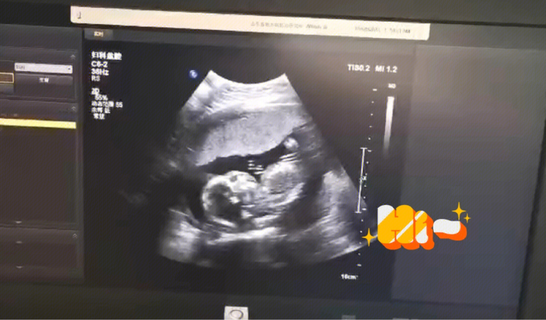 怀孕19周胎儿彩超图图片