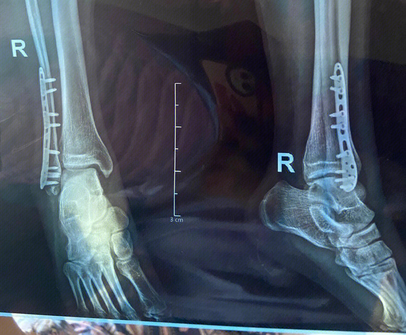 外踝骨折手术切口图谱图片