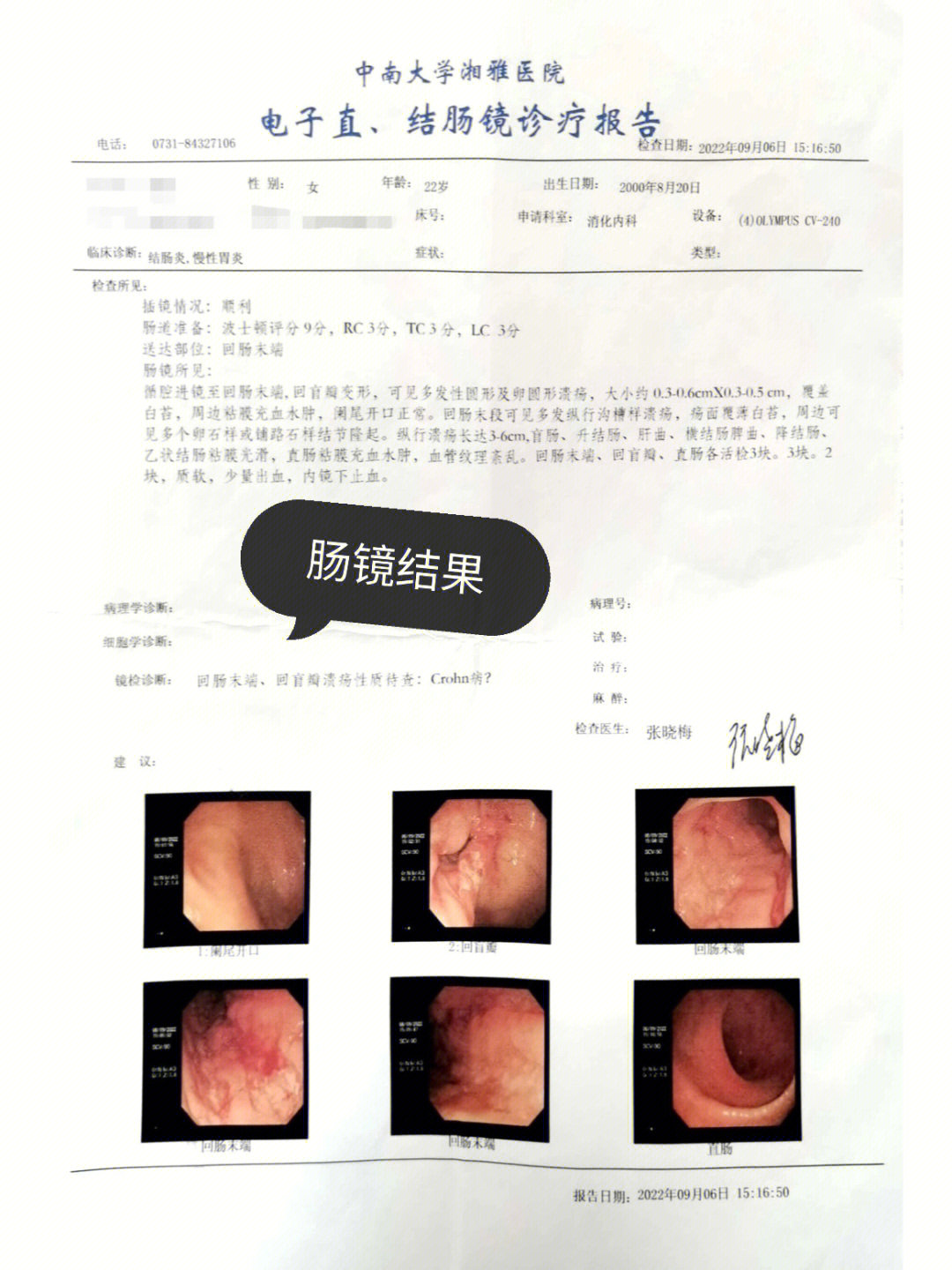 克罗恩早期症状图片图片