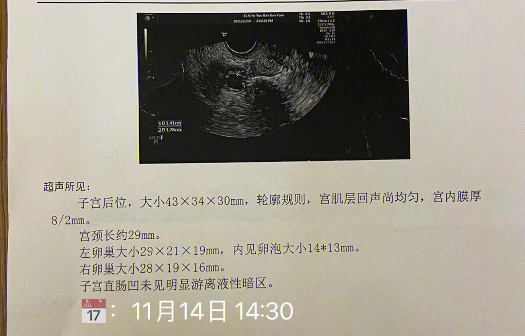 子宫直肠窝见液性暗区图片