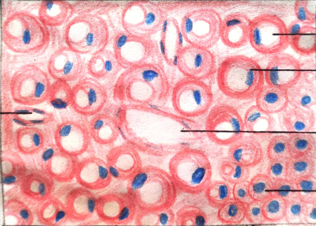 肝细胞脂肪变图片