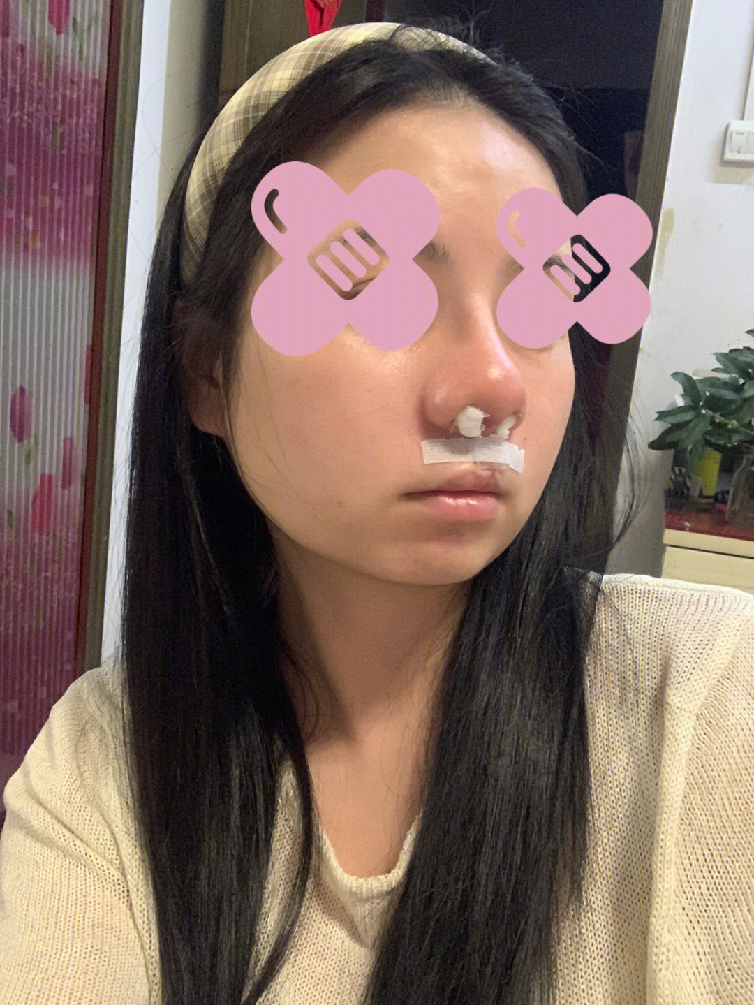 单侧唇裂修复鼻孔好难调整到一样的.取肋骨的鼻头真是又大又圆钝想哭