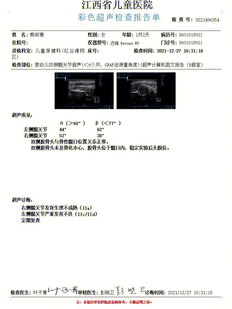 关于新生儿髋关节发育不良