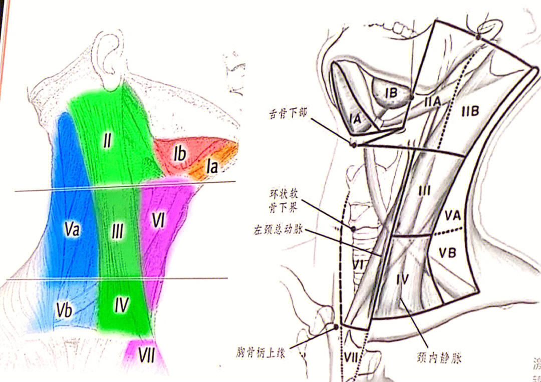 颈部淋巴结分区示意图图片