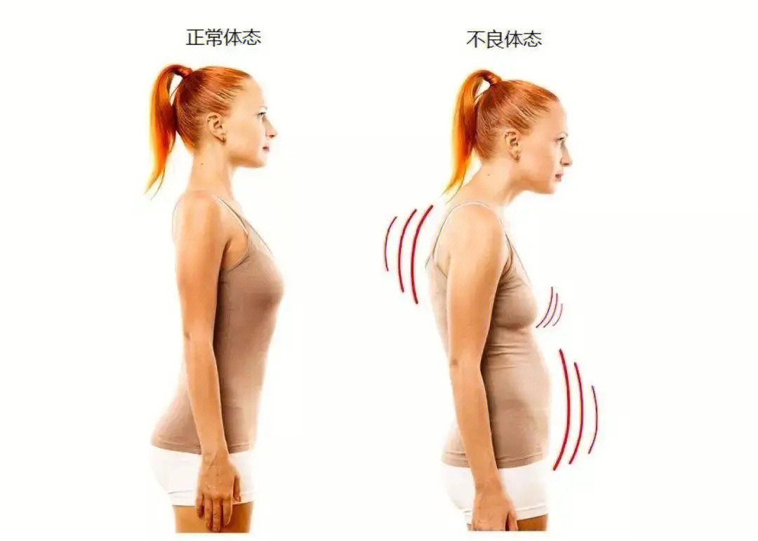 从图中可看到的体态问题:颈部前引含胸驼背 圆肩骨盆前倾明显的上交叉