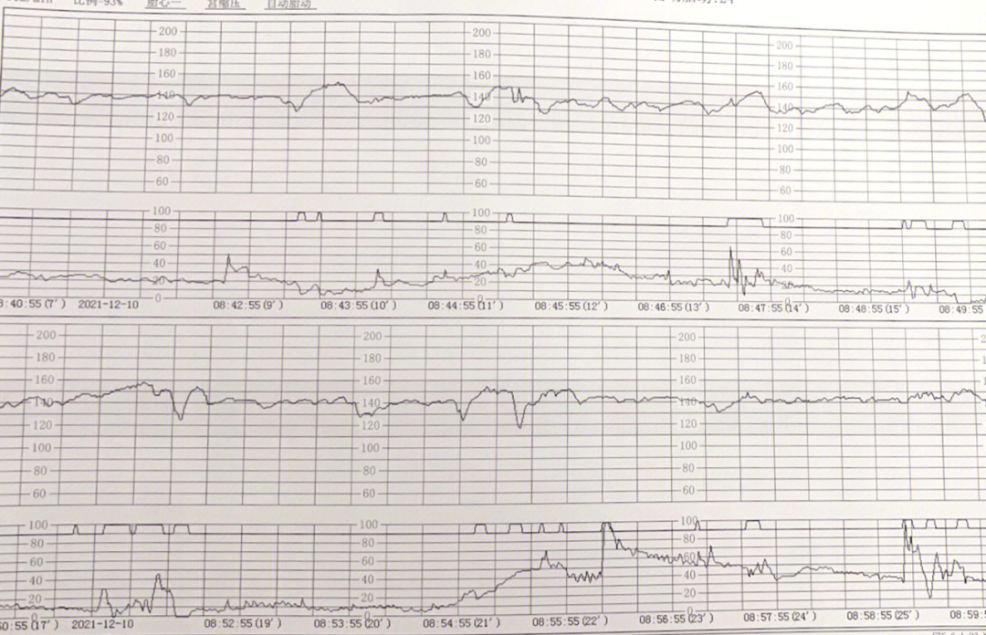 胎心监护合格图片图片