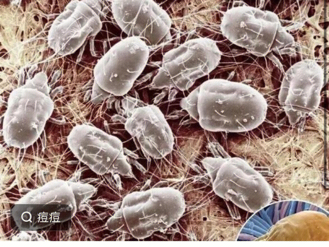 人体螨虫感染图片图片