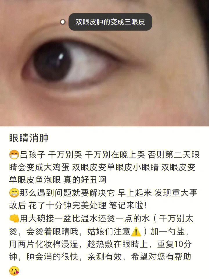 眼睛肿了怎么快速消肿图片